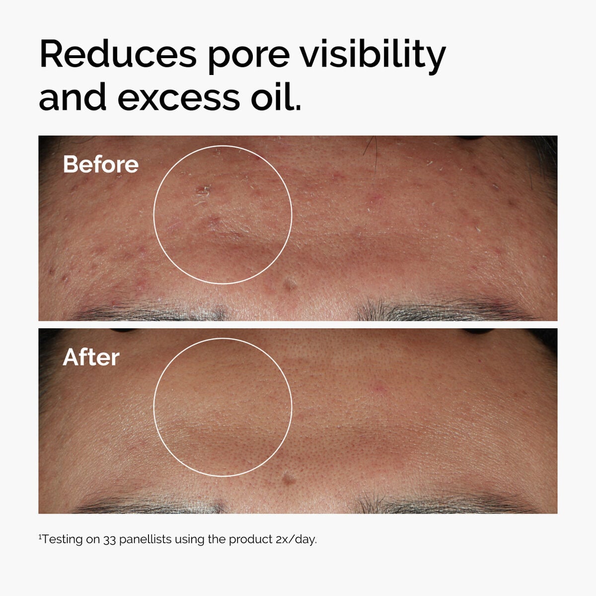 niacinamide-10-zinc-1-g2 ord-niacinamide-zinc-blemish-serum-before-after-pores.jpg
