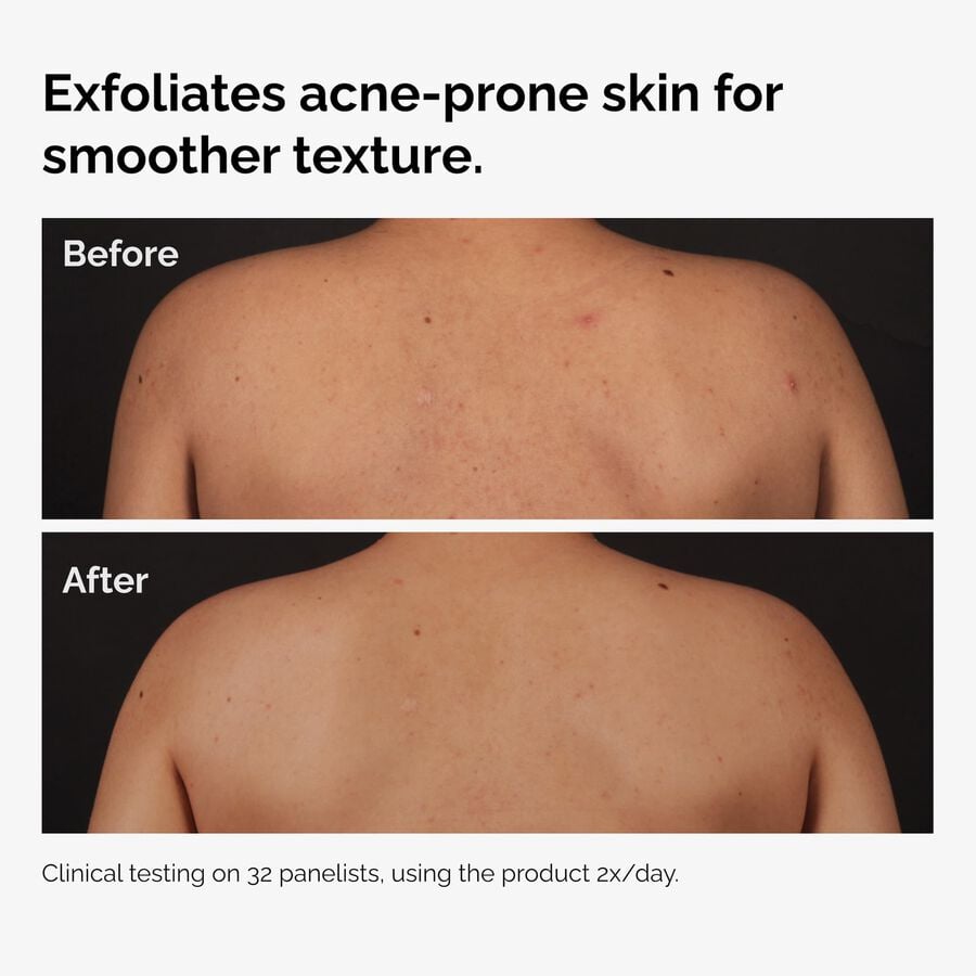 the-body-care-collection-k9 ord-salicylic-acid-body-serum-before-after-graphic-NA.jpg