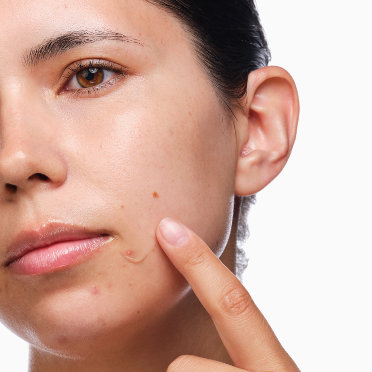 the-acne-set-j2 rdn-the-acne-set-application.png